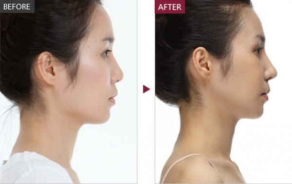 打瘦脸针会反弹吗,打瘦脸针多久恢复,注射瘦脸针的效果,