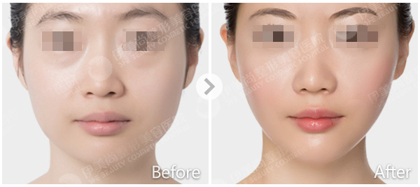 打瘦脸针一般多少钱,注射瘦脸针的价格是多少呢