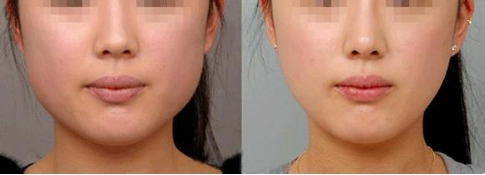 那些人适合打瘦脸针