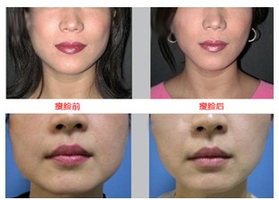 注射瘦脸针的价格