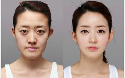 瘦脸针前后对比图