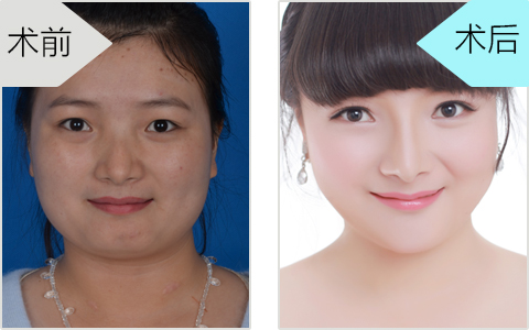 重庆瘦脸针