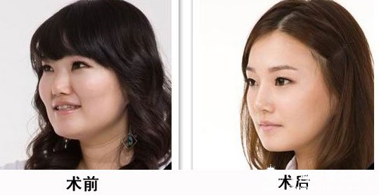 打一次瘦脸针多少钱    