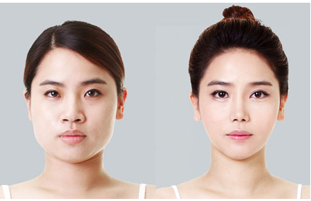 瘦脸针有什么副作用