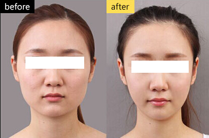 瘦脸针有效果吗