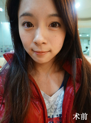 去法令纹前的我