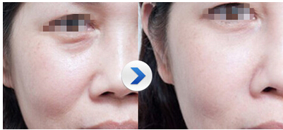 玻尿酸填充凹陷效果,自体脂肪注射,玻尿酸填充凹陷效果好吗