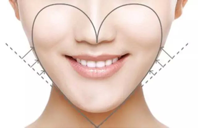 玻尿酸填充除皱,肉毒素注射除皱,玻尿酸注射除皱,玻尿酸填充除皱的优势