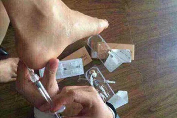 脚后跟打玻尿酸