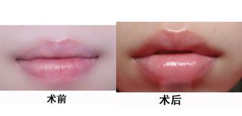 注射玻尿酸丰唇安不安全