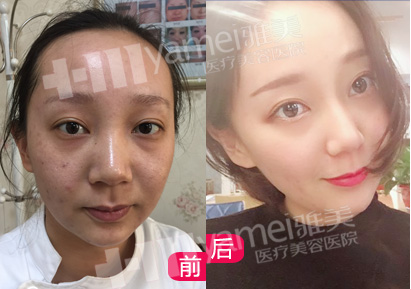 在雅美做黄金软微针，让我素颜也敢晒朋友圈,痘印痘坑,黄金软微针治疗