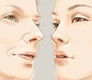 玻尿酸填充法令纹多久恢复,玻尿酸填充法令纹不会有副作用