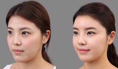 玻尿酸丰额头的效果