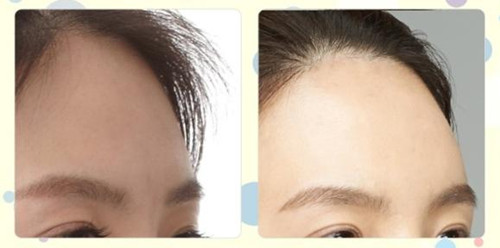 玻尿酸丰额头效果