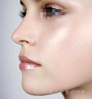 玻尿酸丰脸颊注射方法,注射玻尿酸丰面颊，玻尿酸丰脸颊效果