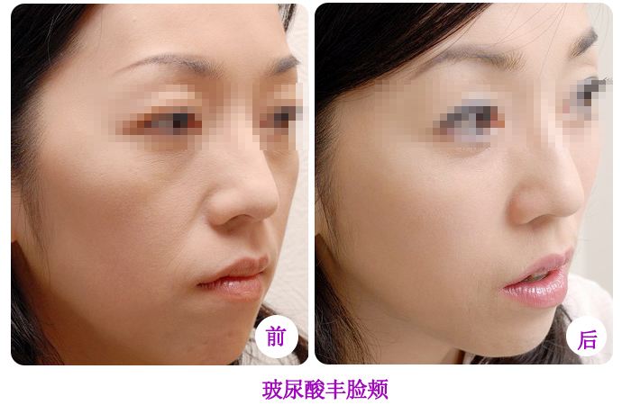 注射玻尿酸丰脸颊,玻尿酸注射丰面颊能维持多久,玻尿酸注射丰面颊的效果，玻尿酸注射丰面颊效果能维持多久