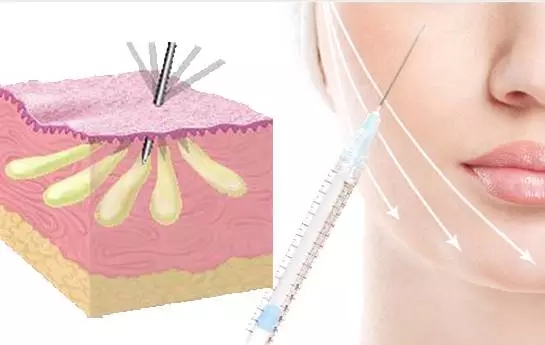 全脸脂肪填充,自体脂肪移植术后,全面部的脂肪填充，全脸脂肪填充多少钱