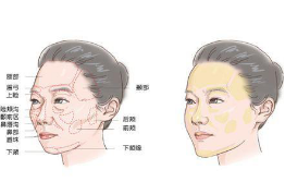 自体脂肪填充术后的注意事项