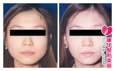 注射瘦脸针前后的效果对比图片