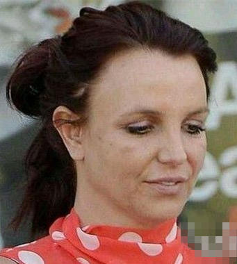 布兰妮满脸黑斑皮肤松弛