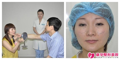 图解：瑞兰玻尿酸注射真实案例