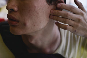 在整形院隆颊后90后小伙脸肿额头起包