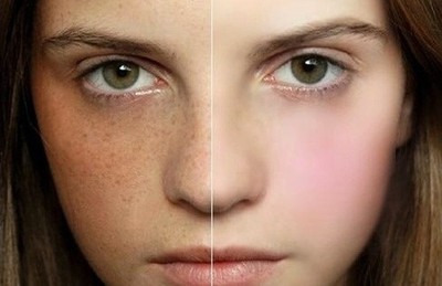 小孩脸上长雀斑