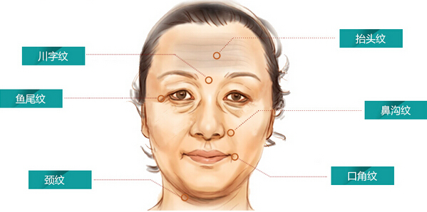 肉毒素和玻尿酸除皱各有所长