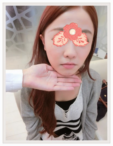 案例：埋线提拉一做 大小脸不见了！