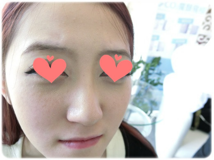 玻尿酸填补泪沟 拯救作为加班狗的我！