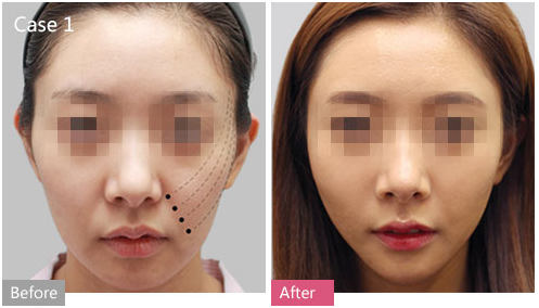 上海做面部年轻化最厉害的医生是谁？